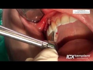 Schablonennavigierte-Implantation-von-zwei-ICX-templant®-Implantaten