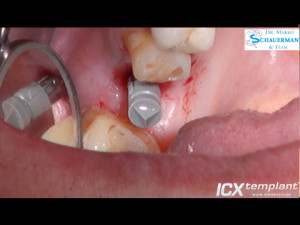 Einzelzahnimplantation-im-Oberkiefer-mit-ICX-MAGELLAN-ICX-SafetyGuide-System