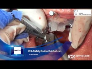 ICX-MAGELLAN-ICX-SafetyGuide-System-Verankerung-einer-Totalprothese-im-Oberkiefer